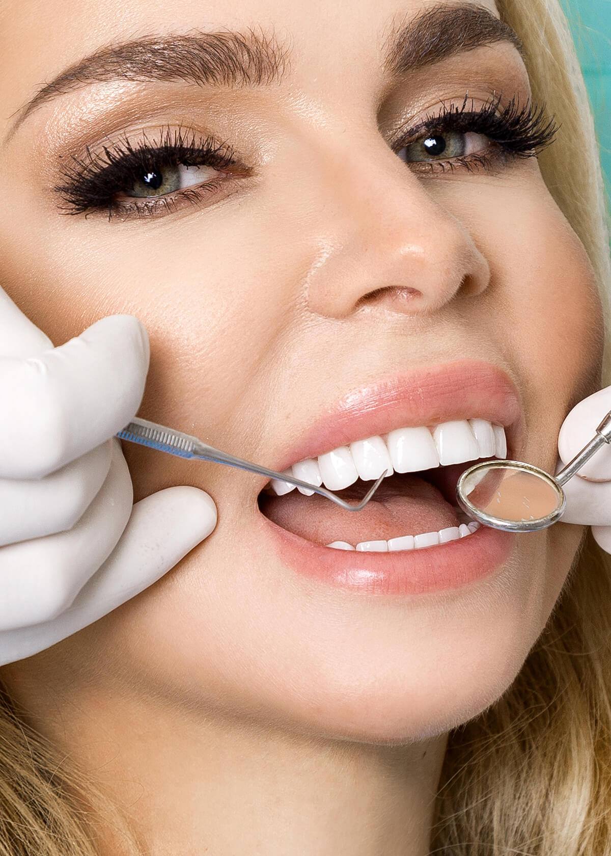 Composite Resin Veneers